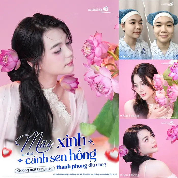 Từng Lỡ Nhiều Job Làm Mẫu Ảnh, GenZ 2K6 Quyết Định Nâng Mũi Để Không Bỡ Lỡ  Cơ Hội