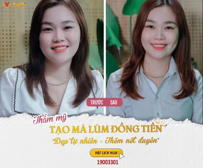 Tạo má lúm đồng tiền: Đẹp tự nhiên - Thêm nét duyên Thanh Vũ Medic Bạc Liêu