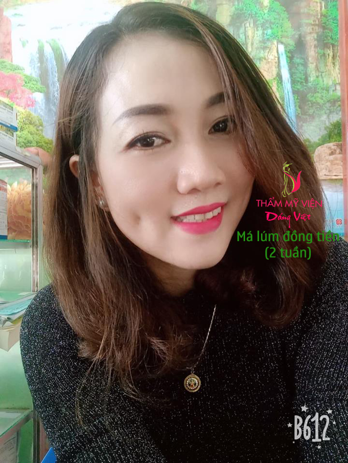 Tạo má lúm đồng tiền