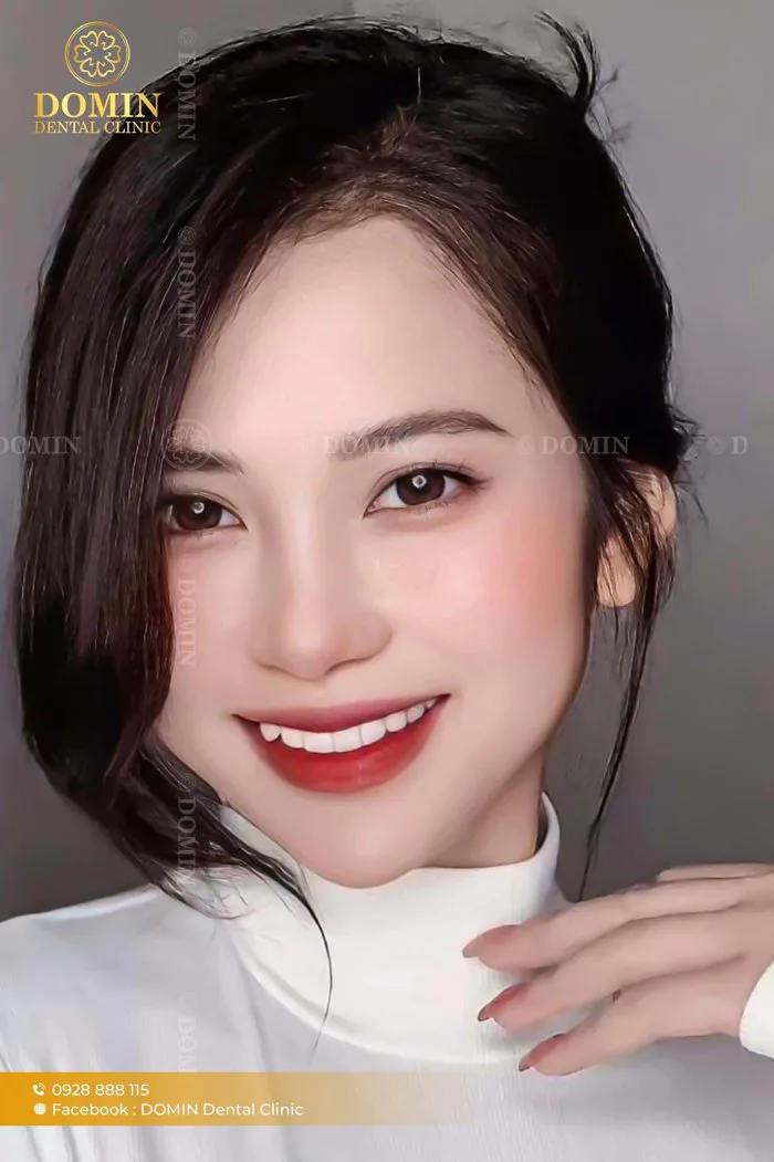 Dáng răng khểnh (Enhanced) là gì? Có nên giữ lại răng khểnh?