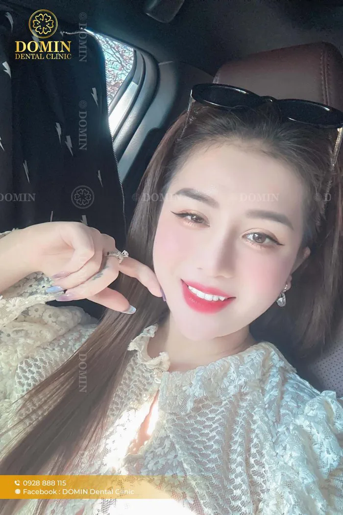 Dáng răng khểnh (Enhanced) là gì? Có nên giữ lại răng khểnh?