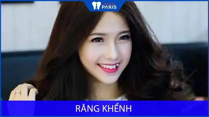 Răng khểnh có ý nghĩa gì, răng khểnh đẹp hay xấu