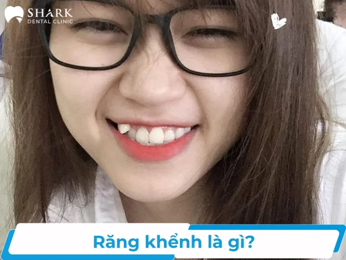 Răng khểnh là gì? Mọc như thế nào? Có đẹp không?