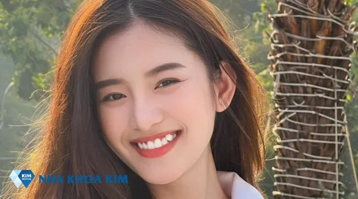 Răng khểnh là đẹp hay xấu? Các kiểu răng khểnh đẹp