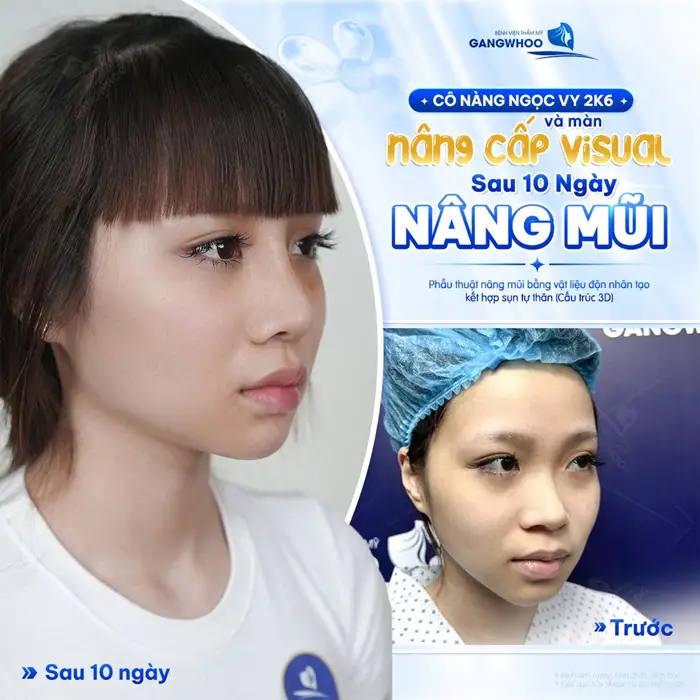 Phẫu Thuật Nâng Mũi Nội Soi 4K Là Gì? Ưu Điểm Và Chi Phí Năm 2026