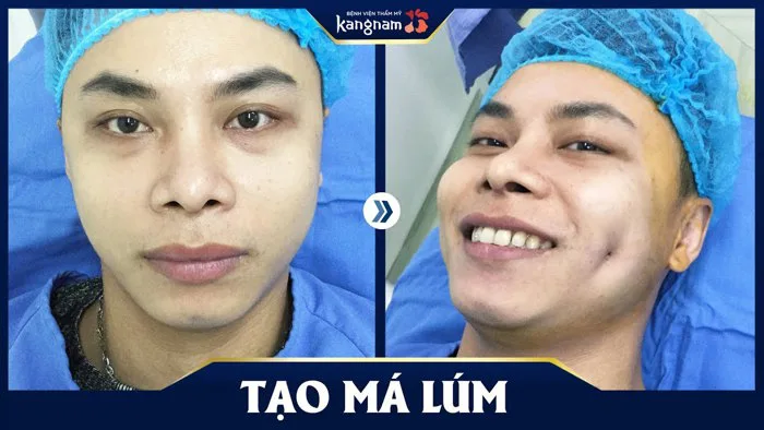 Tạo má lúm đồng tiền cho nam giới