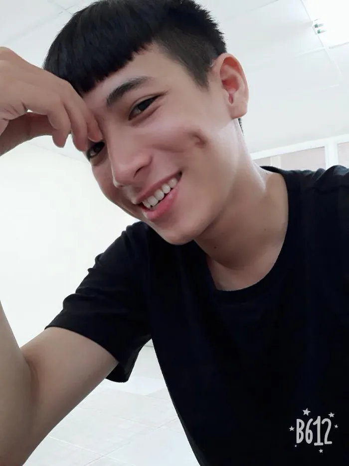 Vì pha nghịch dại hồi bé, thanh niên được khuyến mãi thêm lúm đồng tiền to  bự khiến ai nhìn cũng phải khen duyên
