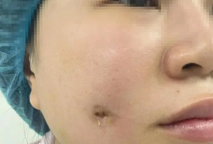 Người phụ nữ bị nhiễm trùng sau khi làm má lúm đồng tiền tại spa | Báo Dân  trí