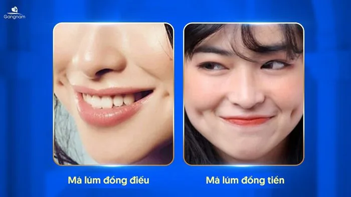Má lúm đồng điếu là gì? Ý nghĩa của má lúm đồng điếu