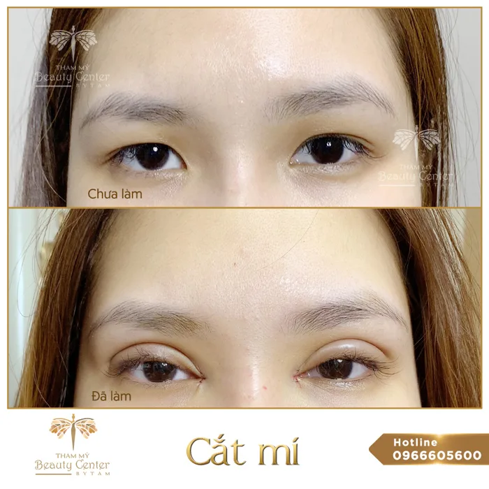 Cắt mắt 2 mí ở đâu đẹp? Địa chỉ cắt mắt hai mí đẹp nhất Cắt mắt 2 mí ở đâu đẹp? Địa chỉ cắt mắt hai mí đẹp nhất