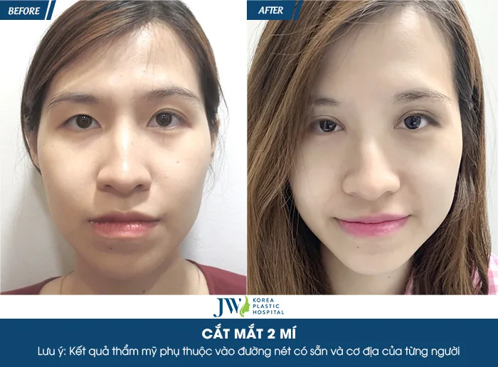 Bấm mí mắt cho nam giới - Bệnh viện thẩm mỹ JW Hàn Quốc Bấm mí mắt cho nam giới - Bệnh viện thẩm mỹ JW Hàn Quốc