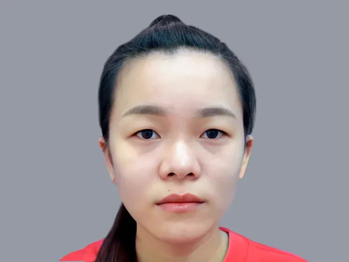 Mắt một mí là gì? Đặc điểm, nguyên nhân và cách cải thiện thẩm mỹ