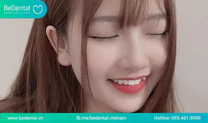 Răng khểnh bên trái: Đẹp hay tiềm ẩn rủi ro sức khỏe răng miệng? - Nha Khoa  BeDental