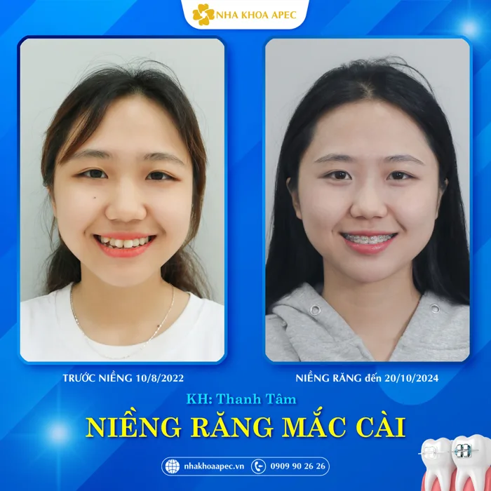 CASE LÂM SÀNG: NIỀNG RĂNG KHẤP KHỂNH SAU 14 THÁNG SẼ THAY ĐỔI RA SAO? - Nha  Khoa Apec - Phòng Khám Răng