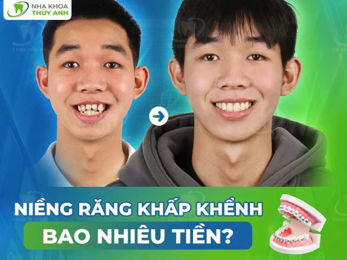 Niềng răng khấp khểnh bao nhiêu tiền? [Chi phí tháng 9.2026]