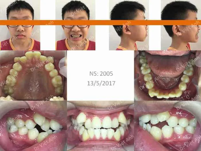 Hình ảnh Niềng Răng: Hình ảnh niềng răng thành công một hàm răng siêu khấp  khểnh lộn xộn - Ca 10 - Bs Việt Anh