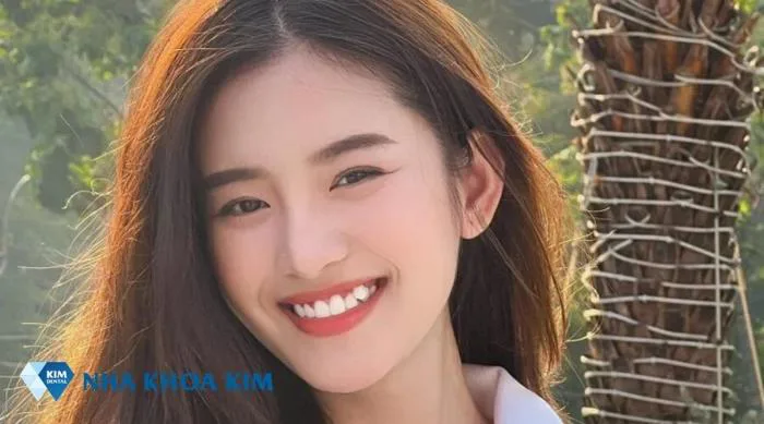 Răng khểnh là đẹp hay xấu? Các kiểu răng khểnh đẹp